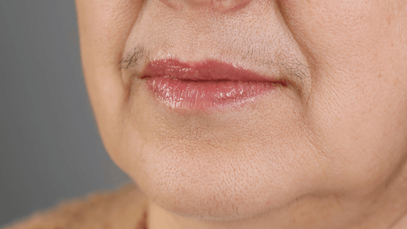 Com técnicas modernas, é possível tratar o sulco naso-geniano mantendo a naturalidade, explica Milton Seigi Hayashi.